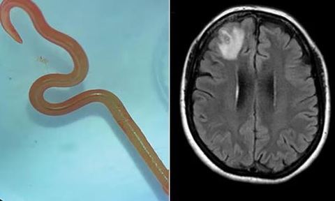Khám phá đầu tiên trên thế giới: Giun tròn sống trong não người phụ nữ Úc - Ảnh 1. Giun Ophidascaris robertsi được các bác sĩ phẫu thuật tại bệnh viện Canberra lấy ra còn sống từ não người phụ nữ - Ảnh: CANBERRA HEALTH