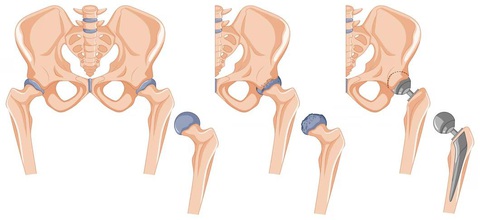 Bác sĩ hướng dẫn cách phục hồi vận động sau phẫu thuật thay khớp háng nhân tạo - Ảnh 1. Bác sĩ hướng dẫn cách phục hồi vận động sau phẫu thuật thay khớp háng nhân tạo - Ảnh 1.