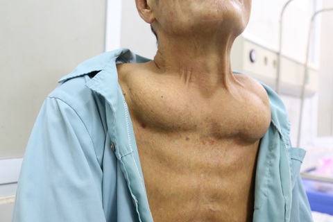 Uống rượu sinh "u mỡ khủng" nhiều nơi - Ảnh 1. Uống rượu nhiều năm, người đàn ông bị u mỡ khủng - Ảnh: BVCC