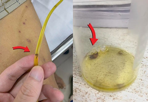 Hình ảnh sán lá gan chui ra từ ống dẫn lưu đường mật - Ảnh: BVCC Hình ảnh sán lá gan chui ra từ ống dẫn lưu đường mật - Ảnh: BVCC
