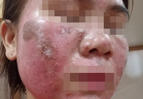 Trường hợp tự peel da gây tổn thương da, bỏng da nghiêm trọng - Ảnh: BVCC Trường hợp tự peel da gây tổn thương da, bỏng da nghiêm trọng - Ảnh: BVCC