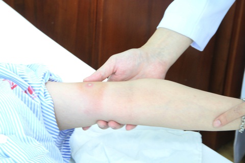 Dọn dẹp trước nhà, người phụ nữ bị ong bắp cày đốt, sốc phản vệ, ngất xỉu - Ảnh 1. Vết ong bắp cày đốt trên cánh tay của nữ bệnh nhân - Ảnh: Bệnh viện cung cấp