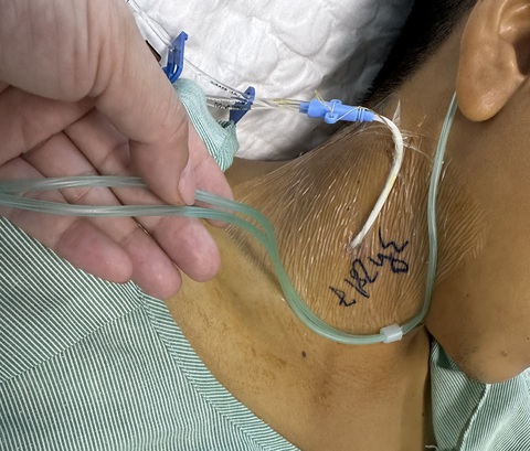 Bệnh nhân nhập viện trong tình trạng vàng da sau khi ăn xôi có màu tím - Ảnh: BVCC Bệnh nhân nhập viện trong tình trạng vàng da sau khi ăn xôi có màu tím - Ảnh: BVCC
