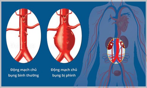 BV Hoàn Mỹ Sài Gòn nâng cao hiệu quả điều trị cho người bệnh tim mạch - Ảnh 1. Phình động mạch chủ là một sát thủ thầm lặng và thường không có triệu chứng