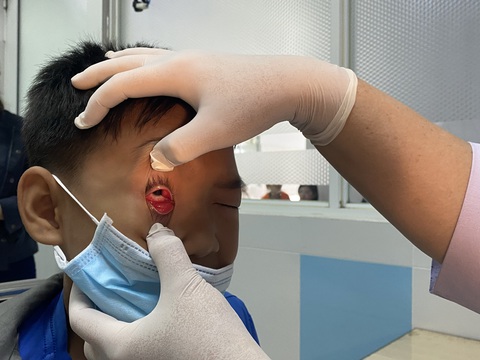 Bác sĩ chuyên khoa mắt kiểm tra, đánh giá mức độ bệnh cho trẻ bị đau mắt đỏ - Ảnh: X.MAI Bác sĩ chuyên khoa mắt kiểm tra, đánh giá mức độ bệnh cho trẻ bị đau mắt đỏ - Ảnh: X.MAI