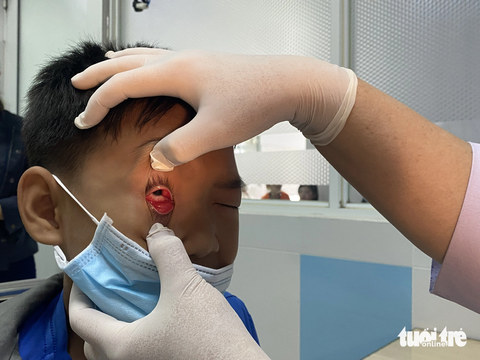 TP.HCM đã xác định tác nhân nhân chính gây đợt bùng phát đau mắt đỏ - Ảnh 3. Theo Sở Y tế TP.HCM, viêm kết mạc xuất huyết là biểu hiện chủ yếu trong đợt dịch mắt đỏ hiện nay tại thành phố - Ảnh: XUÂN MAI