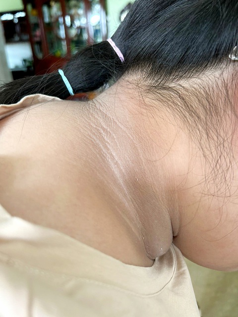 Da cổ bị nâu đen, sần sùi bệnh gì? - Ảnh 1. Da cổ bé bị nâu đen, sần sùi - Ảnh: Bác sĩ Úc cung cấp
