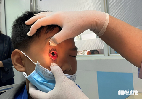 Nhìn vào mắt người bị đau mắt đỏ có bị lây không? - Ảnh 1. Bác sĩ kiểm tra bệnh nhi mắc bệnh đau mắt đỏ khá nặng tại Bệnh viện Nhi đồng 2 (TP.HCM) - Ảnh: XUÂN MAI