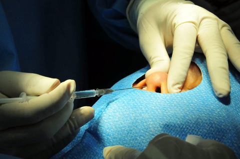 Công an truy tìm 'Thủy thẩm mỹ' nâng mũi gây tai biến và chiếm đoạt tài sản - Ảnh 1. Tiêm filler nâng mũi - Ảnh: THANH ĐẠM