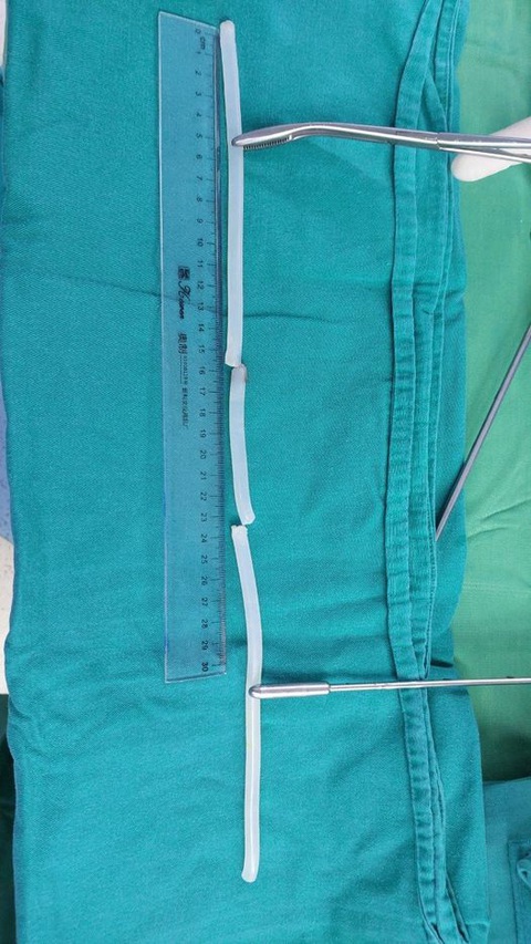 Sau khi uống rượu, quý ông nhét keo nến 40cm vào niệu đạo để tạo khoái cảm- Ảnh 2. Đoạn keo nến dài 40m được người đàn ông nhét vào niệu đạo