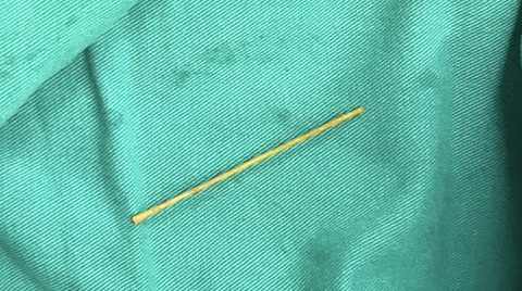 Nam bệnh nhân bị thủng tá tràng do nuốt tăm tre dài 5cm- Ảnh 3. Chiếc tăm tre dài 5cm được các bác sĩ gắp ra từ ổ bụng bệnh nhân N.T.T. - Ảnh: Bệnh viện Đa khoa tỉnh Thanh Hóa cung cấp