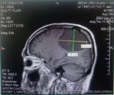 Cắt khối u não khổng lồ cho người đàn ông 65 tuổi- Ảnh 3. Hình ảnh chụp MRI cho thấy khối u có kích thước khổng lồ lấn sâu vào não - Ảnh: NGỌC CƯỜNG