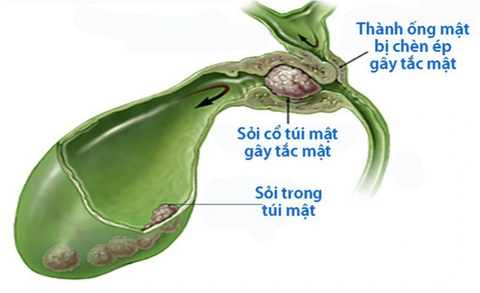 Nhiều thói quen tưởng vô hại dễ dẫn đến nguy cơ sỏi mật, polyp túi mật- Ảnh 1. Ảnh minh họa