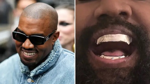 Kanye West chi hơn 20 tỉ đồng để độ hàm răng- Ảnh 1. Kanye West với nửa hàm dưới đính kim cương (trái) và bộ hàm bằng titan mới - Ảnh: LBC