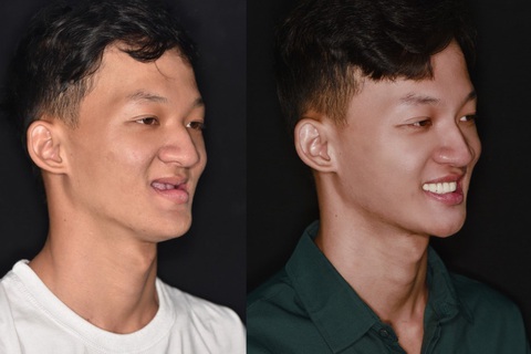 Bước ngoặt mới trong cấy ghép răng cho trường hợp tiêu xương nghiêm trọng- Ảnh 4. Bước ngoặt mới trong cấy ghép răng cho trường hợp tiêu xương nghiêm trọng- Ảnh 4.