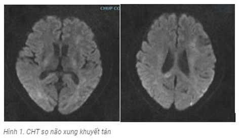 Hệ miễn dịch tấn công não bộ: Căn bệnh viêm não xa lạ dễ gây tử vong- Ảnh 2. Hệ miễn dịch tấn công não bộ: Căn bệnh viêm não xa lạ dễ gây tử vong- Ảnh 2.