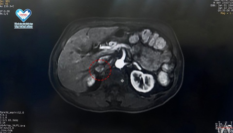 Phát hiện khối u tuyến thượng thận nhờ chụp cộng hưởng từ MRI- Ảnh 1. Khối u được chụp bằng cộng hưởng từ MRI tại BV Tâm Trí Đà Nẵng