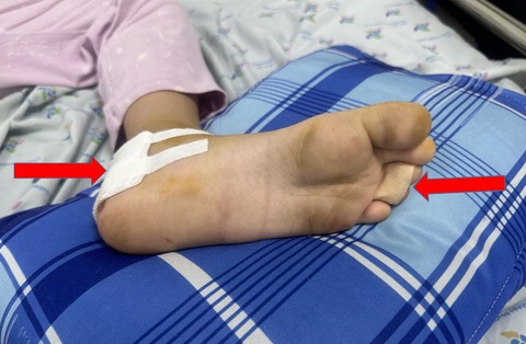Để mắt đến con trẻ trong ngày Tết, tránh các tai nạn sinh hoạt đau lòng- Ảnh 1. Trẻ bị giập nát phần gót chân và ngón chân thứ 3 và 4 bên trái do cuốn vào căm bánh xe - Ảnh: Bác sĩ cung cấp