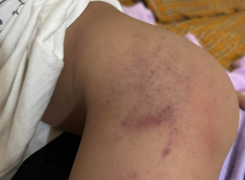 Vết bầm tím trên cơ thể bé D. do bị người giữ trẻ đánh được gia đình bé phát hiện vào trưa ngày 30-12 - Ảnh: Gia đình cung cấp Vết bầm tím trên cơ thể bé D. do bị người giữ trẻ đánh được gia đình bé phát hiện vào trưa 30-12-2023 - Ảnh: Gia đình cung cấp