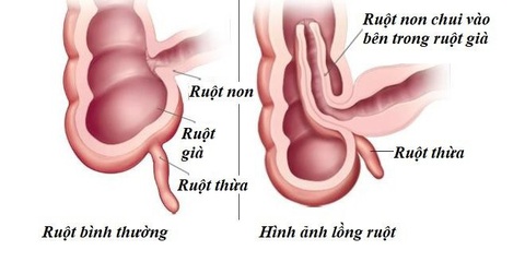 Bệnh viện quốc tế Tâm Trí Hồng Ngự cấp cứu lồng ruột trẻ em bằng kỹ thuật bơm hơi- Ảnh 1. Lồng ruột là một tình trạng cấp cứu ngoại khoa thường gặp ở trẻ em