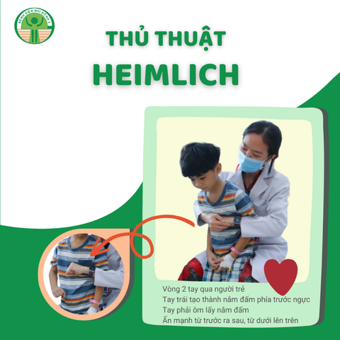 Trẻ mắc dị vật đường thở, phụ huynh cần xử lý sao?- Ảnh 4. Thủ thuật Heimlich phụ huynh có thể áp dụng với trẻ trên 3 tuổi khi mắc dị vật đường thở - Ảnh: Bệnh viện cung cấp