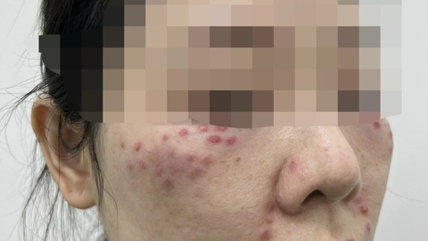 Tế bào gốc làm đẹp: Có phải thần dược để 'nâng cấp' nhan sắc?- Ảnh 1. Khuôn mặt của một người phụ nữ chi chít nốt tiêm sưng nề, đỏ đau sau tiêm “tế bào gốc” - Ảnh: BVCC