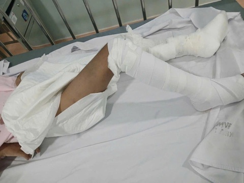 Bé trai 6 tuổi, nghi bị cha bạo hành, bị phỏng nước sôi độ 2-3 - Ảnh 1.