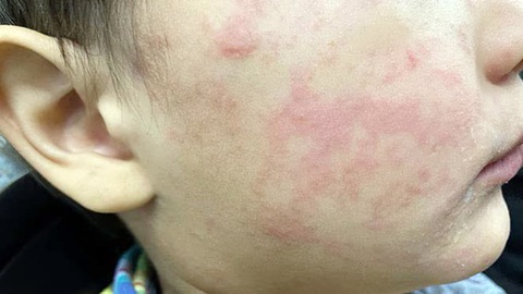 Nhận biết ban do sởi hay phát ban do vi rút - Ảnh 1. Nhận biết ban do sởi hay phát ban do vi rút - Ảnh 1.