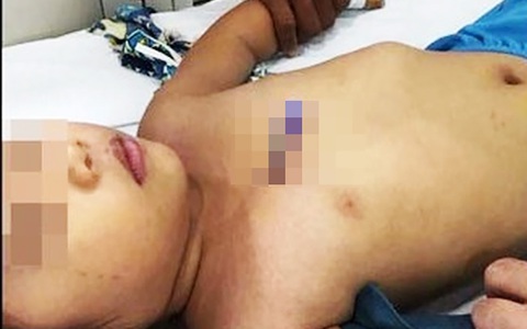 Cứu sống bé gái bị bút bi đâm thấu ngực - Ảnh 1. Cứu sống bé gái bị bút bi đâm thấu ngực - Ảnh 1.