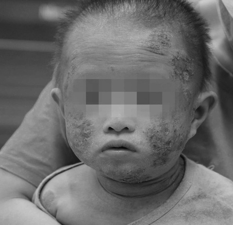 Bé trai 1 tuổi phồng rộp cả mặt, chảy dịch vì viêm da cơ địa - Ảnh 1. Bé trai 1 tuổi phồng rộp cả mặt, chảy dịch vì viêm da cơ địa - Ảnh 1.