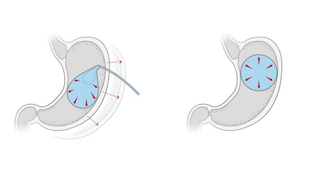 Chế tạo bóng dạ dày giúp giảm cân lâu dài - Ảnh 2. Chế tạo bóng dạ dày giúp giảm cân lâu dài - Ảnh 2.