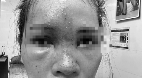 Bệnh nhân thâm tím, hoại tử vùng mũi vì tiêm filler tại cơ sở không phép - Ảnh: BVCC Bệnh nhân thâm tím, hoại tử vùng mũi vì tiêm filler tại cơ sở không phép - Ảnh: BVCC