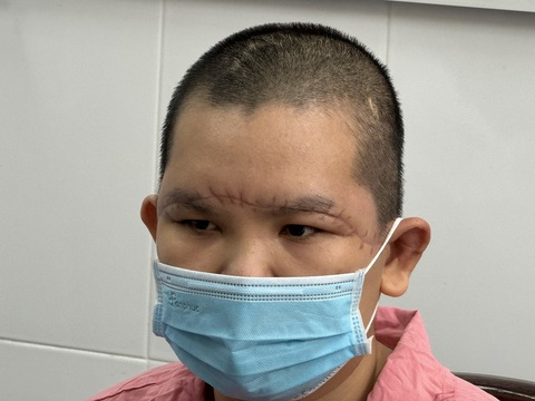 Lần đầu tiên Bệnh viện Chợ Rẫy nối thành công toàn bộ da đầu bị lóc cho bệnh nhân- Ảnh 3. Phần da đầu bị máy cuốn lóc toàn bộ sau phẫu thuật hồi phục ngoạn mục - Ảnh: THU HIẾN