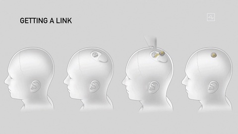 Hình minh họa quy trình cấy ghép chip vào não người của Neuralink - Ảnh: AFP Hình minh họa quy trình cấy ghép chip vào não người của Neuralink - Ảnh: AFP