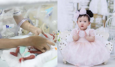 Tôn vinh phác đồ 'giờ vàng' cứu sống trẻ sinh cực non- Ảnh 4. Bé Bối Bối sinh non ở tuần 25 (bên trái), hiện gần 3 tuổi phát triển khỏe mạnh (bên phải) - Ảnh: Gia đình cung cấp