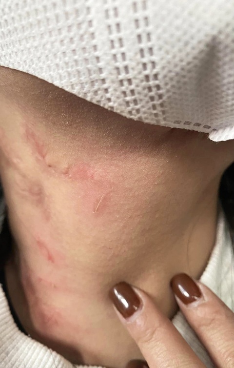 Khách tố bị nhà xe hành hung, bỏ giữa cao tốc, thiếu tướng Đinh Văn Nơi chỉ đạo điều tra- Ảnh 3. Hình ảnh vết thương tại vùng cổ của người phụ nữ trong bài phản ánh - Ảnh: Facebook Bạch Thị D.