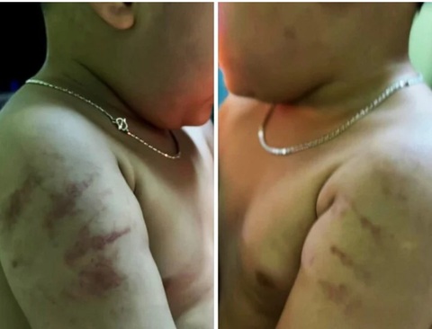 Bé trai có nhiều vết bầm trên tay sau khi được gia đình đón từ Trường mầm non Sao Sáng về nhà - Ảnh: T.T Bé trai có nhiều vết bầm trên tay sau khi được gia đình đón từ Trường mầm non Sao Sáng về nhà - Ảnh: H.T.
