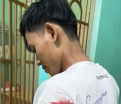 Đi trộm bị truy đuổi, rút dao chém bảo vệ dân phố bị thương- Ảnh 2. Anh Nguyễn Minh Hiến, bảo vệ dân phố phường Phước Bình, bị thương ở vai trái - Ảnh: CTV