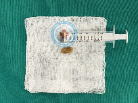 Trẻ 10 tháng tuổi suy hô hấp do hóc dị vật: Cần sơ cứu đúng cách tránh tử vong- Ảnh 2. Hạt đậu phộng da cá được lấy ra từ phế quản bệnh nhi - Ảnh: BVCC