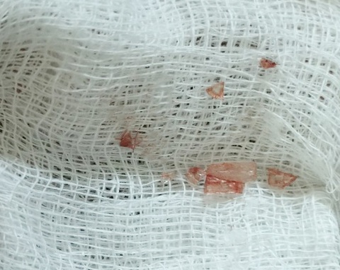 Người đàn ông bị mảnh vỡ kính cận găm vào mũi hơn một tháng không hay biết- Ảnh 1. Các mảnh kính vỡ được lấy ra từ mũi bệnh nhân H.T.G. - Ảnh: Bệnh viện cung cấp