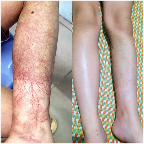 Người bệnh bị dị dạng mạch máu trước và sau khi tiêm cồn - Ảnh: BVCC Người bệnh bị dị dạng mạch máu trước và sau khi tiêm cồn - Ảnh: BVCC