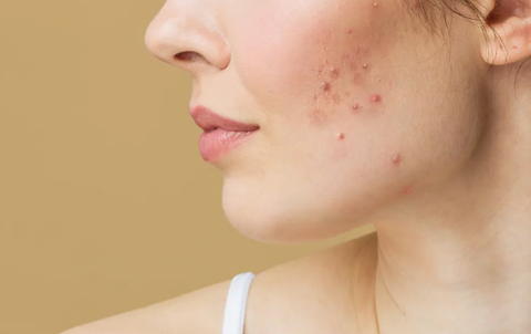 Phát hiện chất gây ung thư hàm lượng cao trong một số loại kem trị mụn- Ảnh 1. Kết quả kiểm tra độc lập cho thấy trong một số loại kem trị mụn có chứa hàm lượng cao chất gây ung thư - Ảnh: GETTY IMAGES