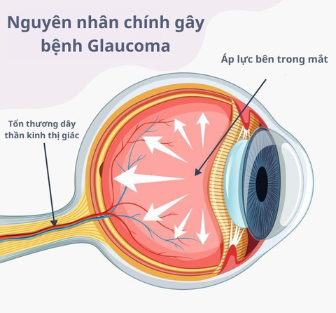 Nguyên nhân phổ biến khiến hàng triệu người trên thế giới mắc bệnh mù lòa- Ảnh 2. Nguyên nhân phổ biến khiến hàng triệu người trên thế giới mắc bệnh mù lòa- Ảnh 2.