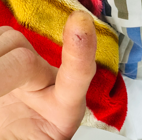 Bị cu li cắn, nam giới 31 tuổi nhiễm độc nặng và sốc phản vệ- Ảnh 1. Bệnh nhân bị cu li cắn vào đầu ngón tay - Ảnh bệnh viện cung cấp