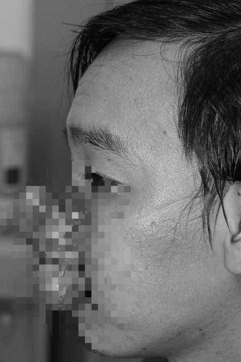 Người đàn ông mang khối u to trên mũi đã có gương mặt gần như bình thường- Ảnh 1. Bệnh nhân có khối u to trên mũi - Ảnh: Bệnh viện cung cấp
