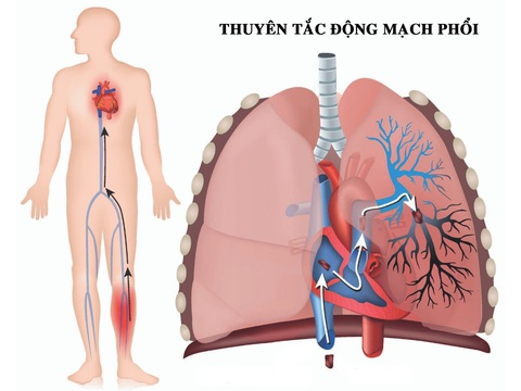 Cẩn thận bệnh 'sát thủ ẩn mình' thuyên tắc động mạch phổi gây tử vong nhanh trong 1-2 giờ- Ảnh 3. Ảnh minh họa - BVCC