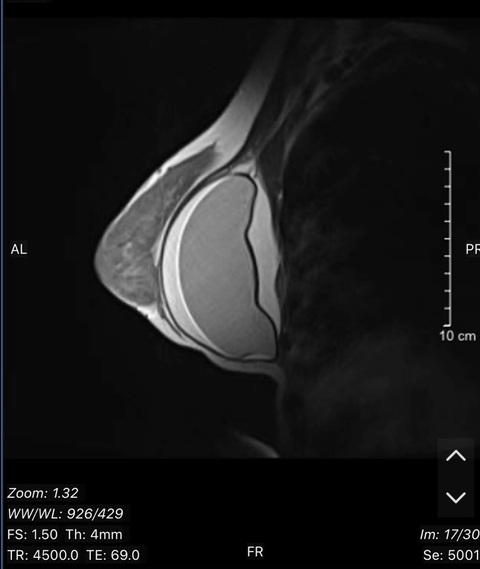 Hình ảnh MRI ngực trái của bệnh nhân vỡ túi ngực - Ảnh: Bác sĩ cung cấp Hình ảnh MRI ngực trái của bệnh nhân vỡ túi ngực - Ảnh: Bác sĩ cung cấp