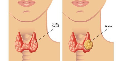 U giáp, ung thư tuyến giáp nên giữ hay cắt bỏ?- Ảnh 2. U lành tuyến giáp - Ảnh: BSCC