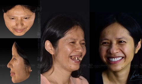 Nha khoa Nhân Tâm ứng dụng kỹ thuật số trong điều trị- Ảnh 3. Hình dung cụ thể nụ cười sau điều trị với công nghệ quét mặt 3 chiều