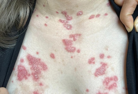 Tưởng liệt do xương khớp, không ngờ là lupus ban đỏ gây bệnh- Ảnh 3. Biểu hiện trên da ở bệnh nhân lupus ban đỏ - Ảnh: BSCC